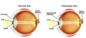 Eye Surgery Farsightedness