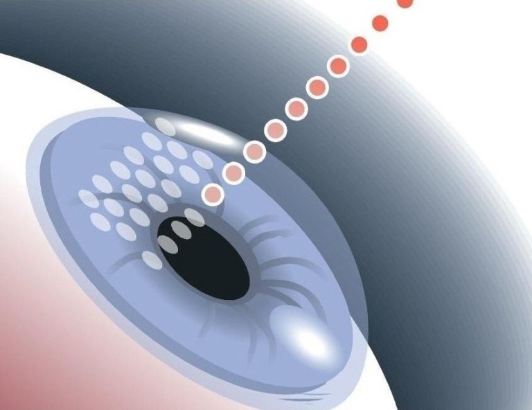 The Eye Clinic Surgicenter How is Laser Eye Surgery Performed? Eye Clinic Surgicenter