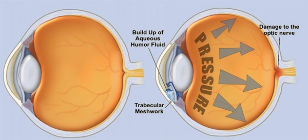 Glaucoma